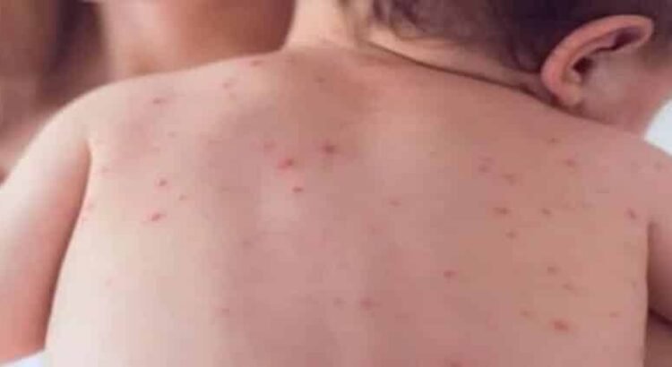 Aumentan casos de varicela un 35% en Hidalgo durante 2025