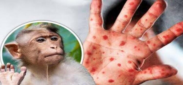 Confirman seis casos de viruela del mono en Hidalgo