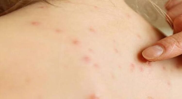 Hidalgo refuerza medidas sanitarias ante riesgo de sarampión y repunte de dengue