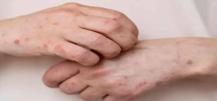 Tras detección de primer caso de sarampión en Hidalgo, refuerzan vacunación