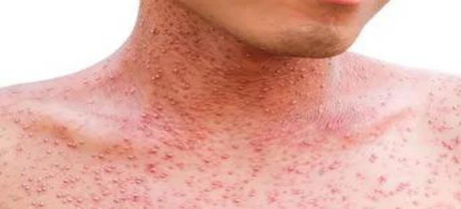 Hidalgo aumenta precauciones contra sarampión, van 7 casos confirmados